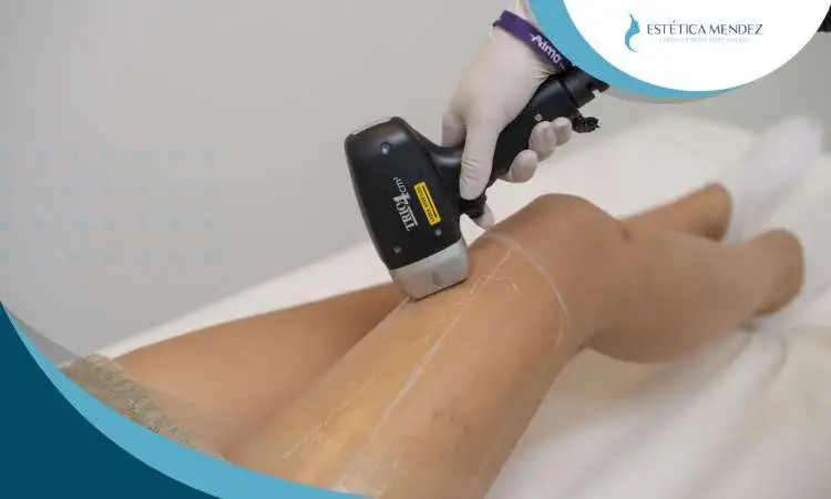 depilacion-laser-piernas-beneficios
