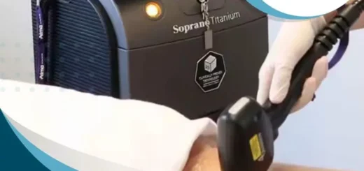 depilacion-laser-soprano-mejor-opcion