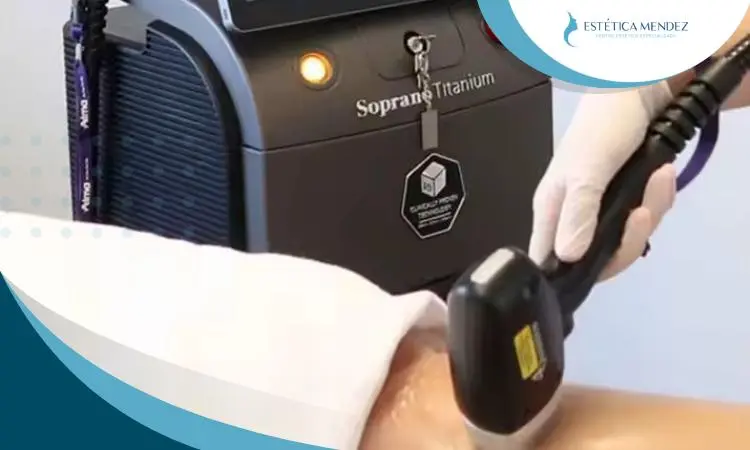 depilacion-laser-soprano-mejor-opcion