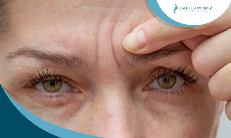 botox-para-arrugas-todo-lo-que-debes-saber