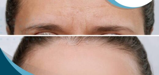 botox-rejuvenecimiento-facial