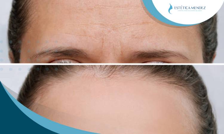 botox-rejuvenecimiento-facial