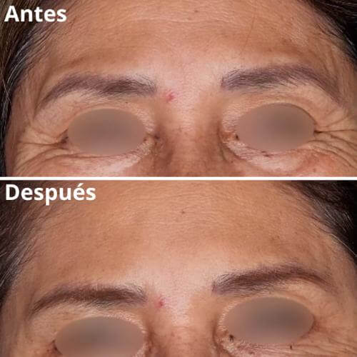 botox-rejuvenecimiento-resultados-1