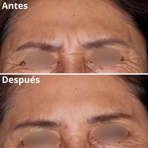 botox-rejuvenecimiento-resultados-2
