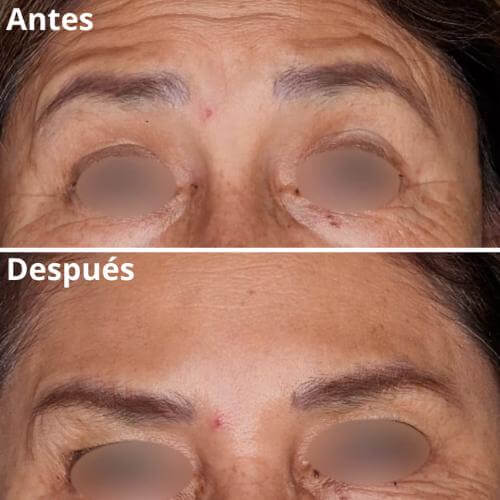 botox-rejuvenecimiento-resultados-3