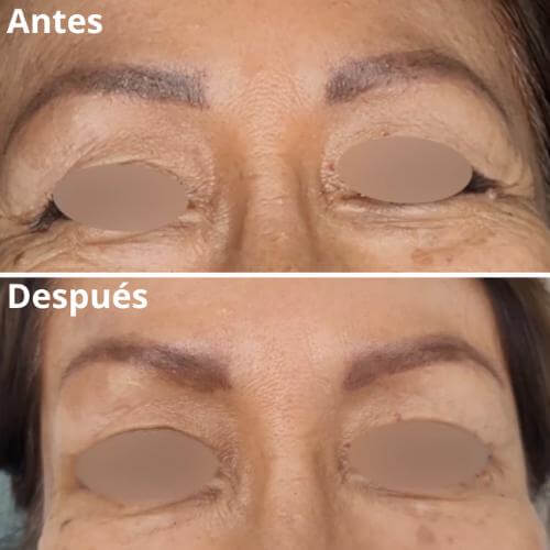 botox-rejuvenecimiento-resultados-4