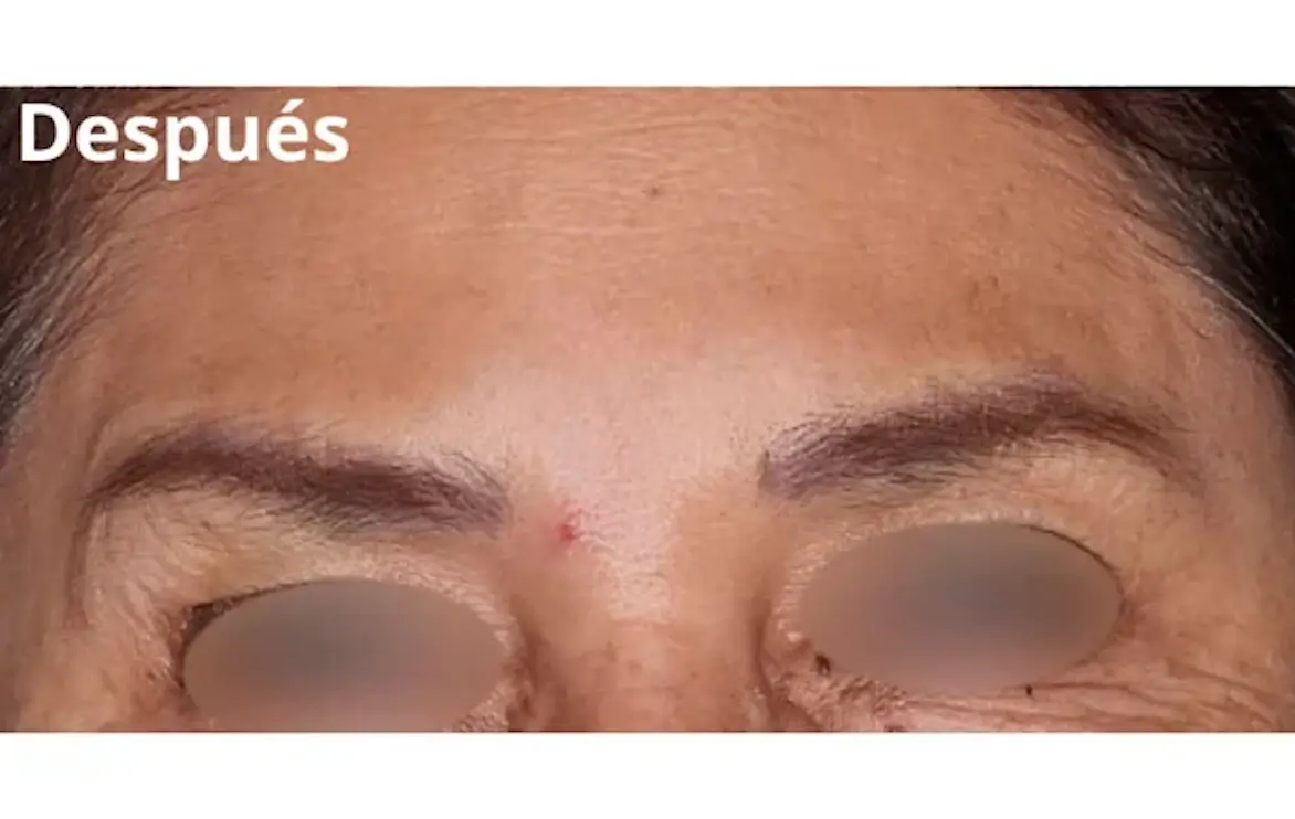 Imagen después del botox